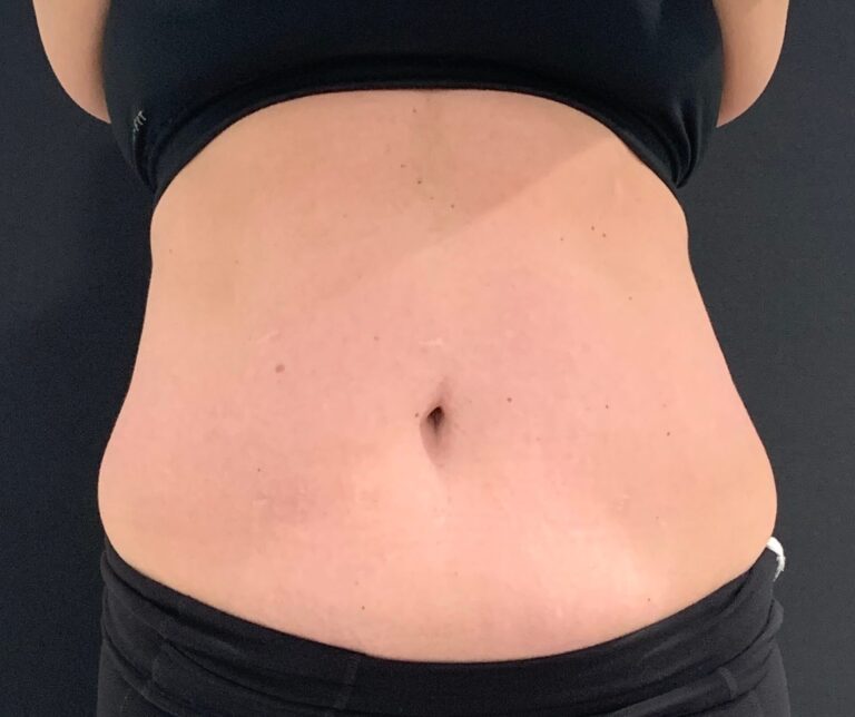 Before photo: EMSCULPT NEO®