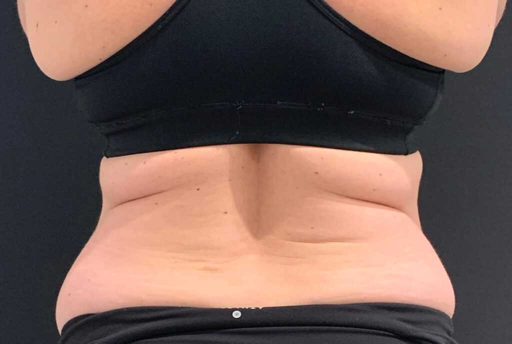 Before photo: EMSCULPT NEO® – Back view