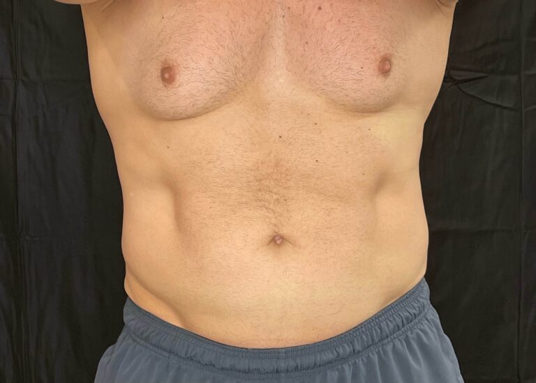 After photo: EMSCULPT NEO®