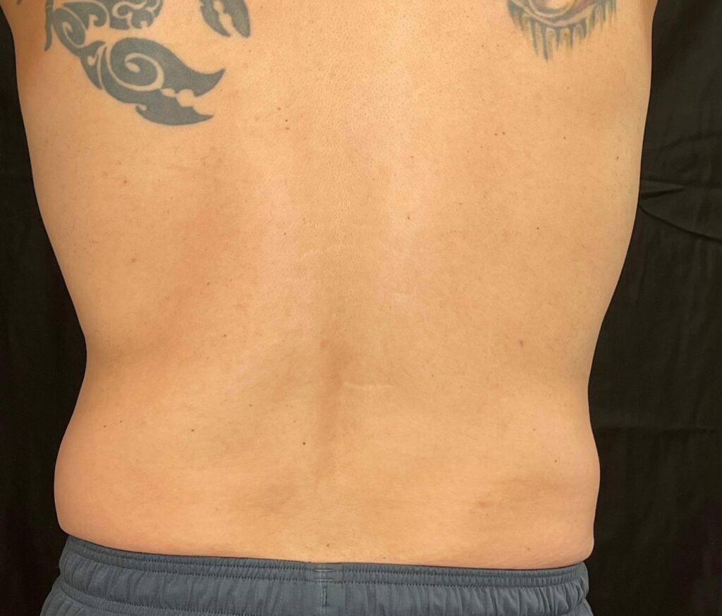 After photo: EMSCULPT NEO® – Back view