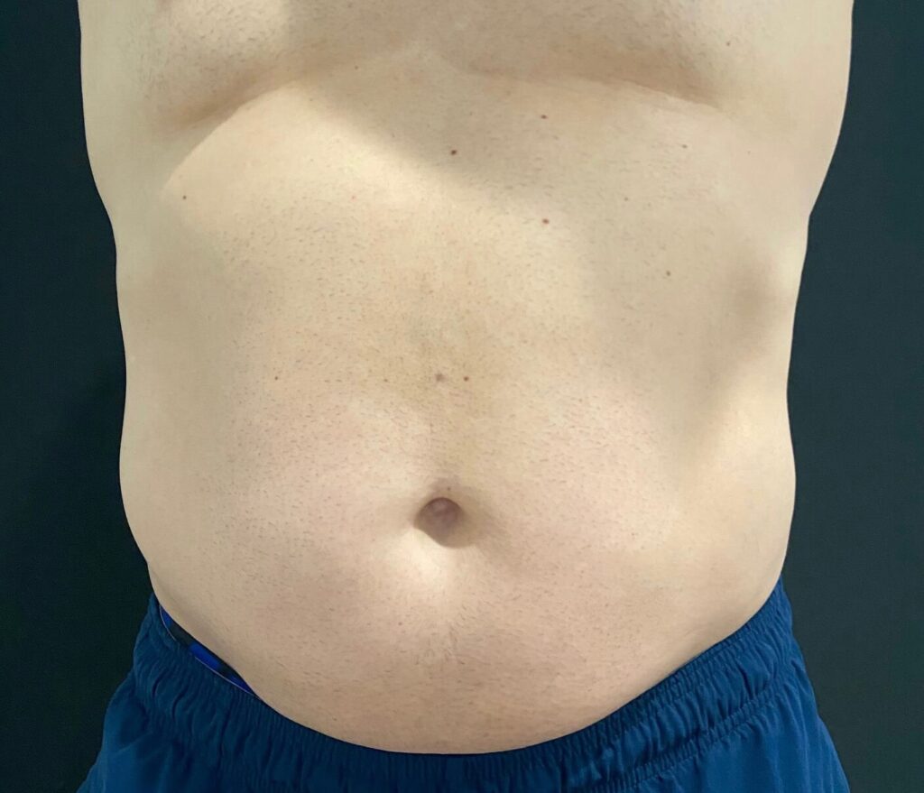 Before photo: EMSCULPT NEO® – Front view