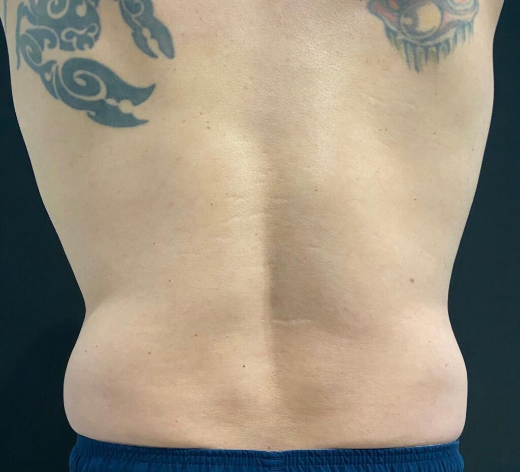 Before photo: EMSCULPT NEO® – Back view